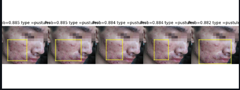 Acne Detector